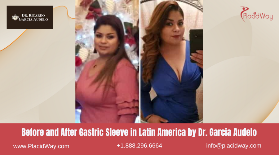 Gastric Sleeve in Latin America Before and After Images - Dr Garcia Audelo