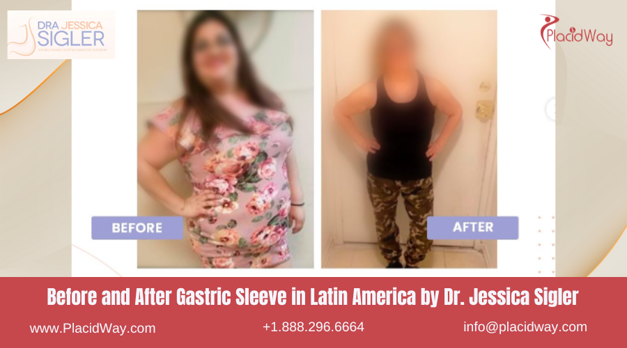 Gastric Sleeve in Latin America Before and After Images - Dr Jessica Sigler