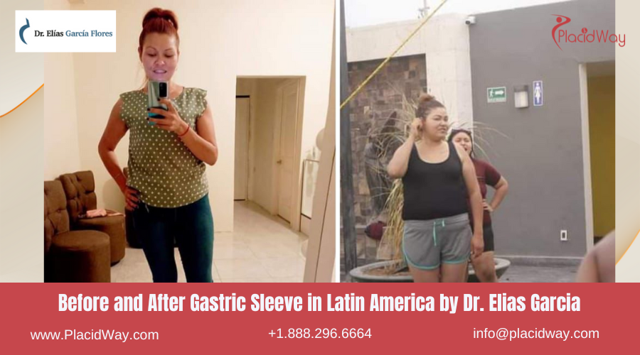 Gastric Sleeve in Latin America Before and After Images - Elias Garcia