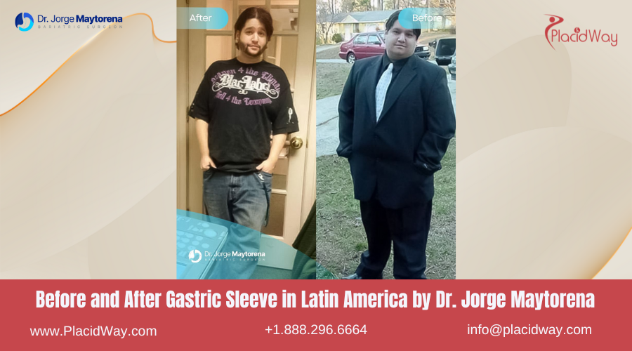 Gastric Sleeve in Latin America Before and After Images - Dr. Jorge Maytorena