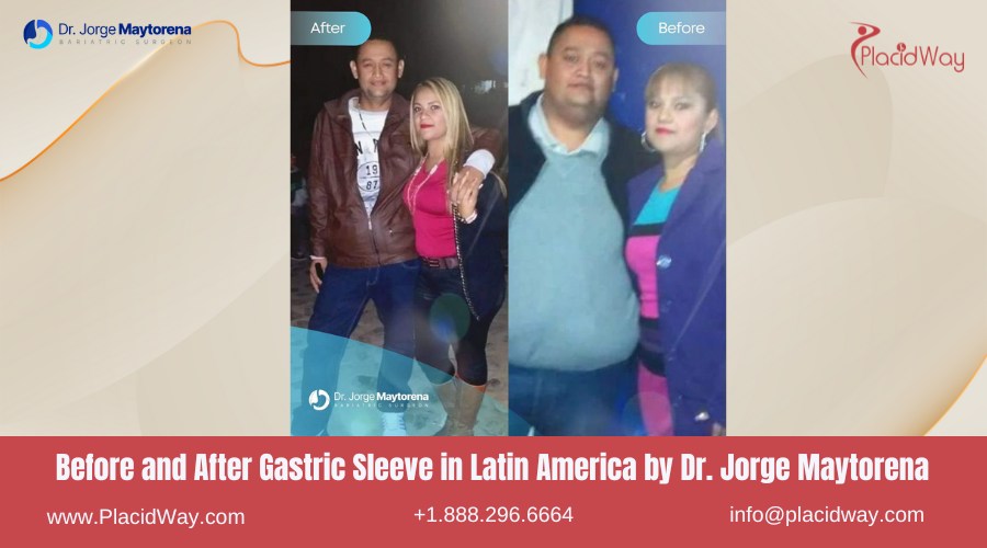 Gastric Sleeve in Latin America Before and After Images - Jorge Maytorena