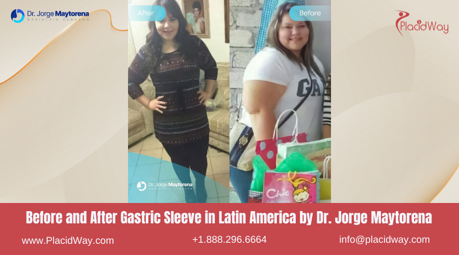 Gastric Sleeve in Latin America Before and After Images - Jorge Maytorena Clinic