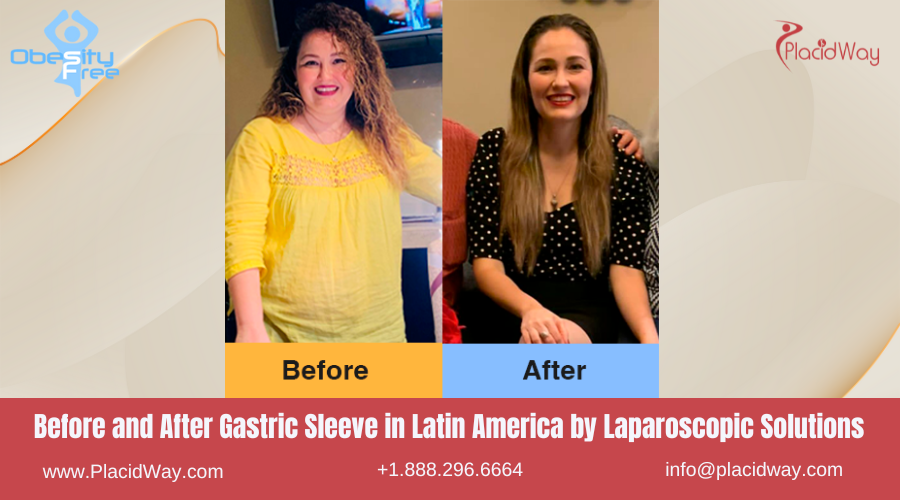 Gastric Sleeve in Latin America Before and After Images - Laparoscopic Solutions