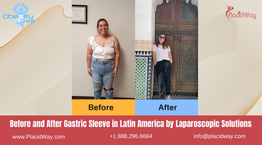 Gastric Sleeve in Latin America Before and After Images - Laparoscopic Solutions Clinic