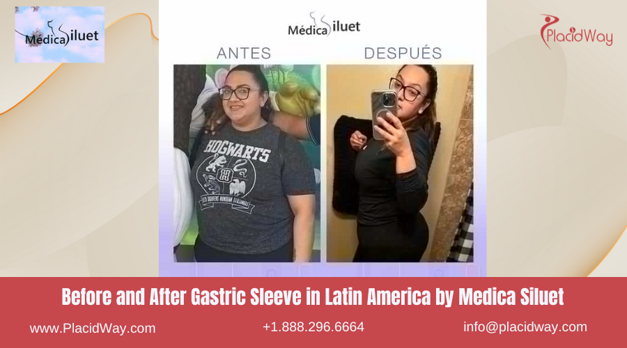Gastric Sleeve in Latin America Before and After Images - Medica Siluet