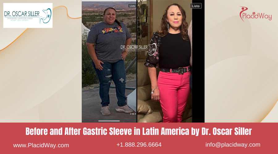 Gastric Sleeve in Latin America Before and After Images - Oscar Siller
