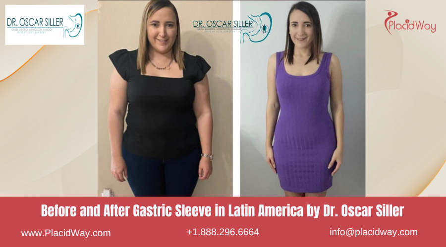 Gastric Sleeve in Latin America Before and After Images - Dr. Oscar Siller
