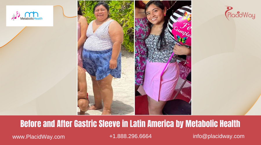 Gastric Sleeve in Latin America Before and After Images - Metabolic Health