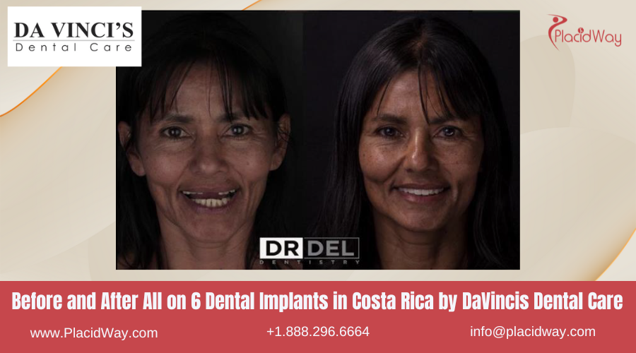 All on 6 Dental Implants in Costa Rica by DaVincis Dental Care - Before and After