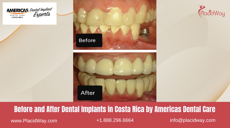 Dental Implants in Costa Rica by Americas Dental Care - Before and After