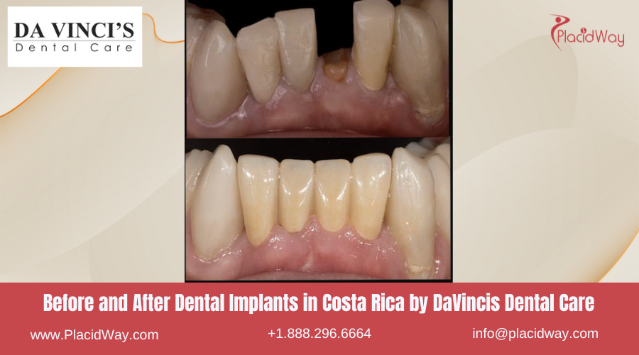 Dental Implants in Costa Rica by Da Vinci - Before and After