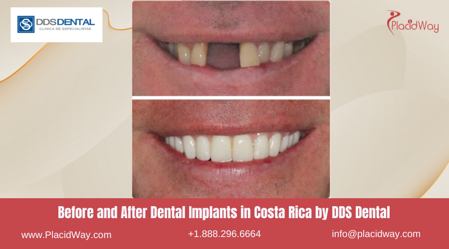 Dental Implants in Costa Rica by DDS Dental - Before and After
