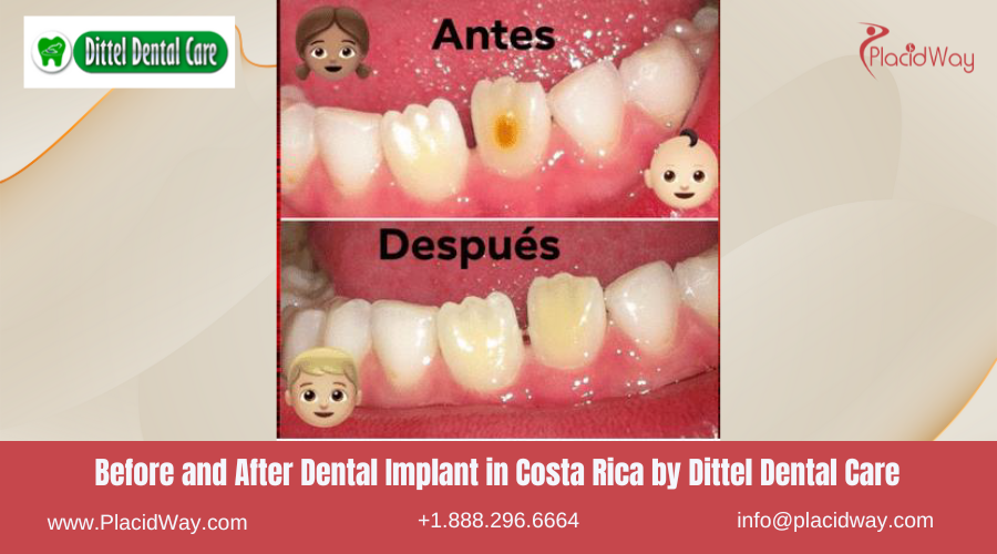 Dental Implants in Costa Rica by Dittel Dental Care - Before and After