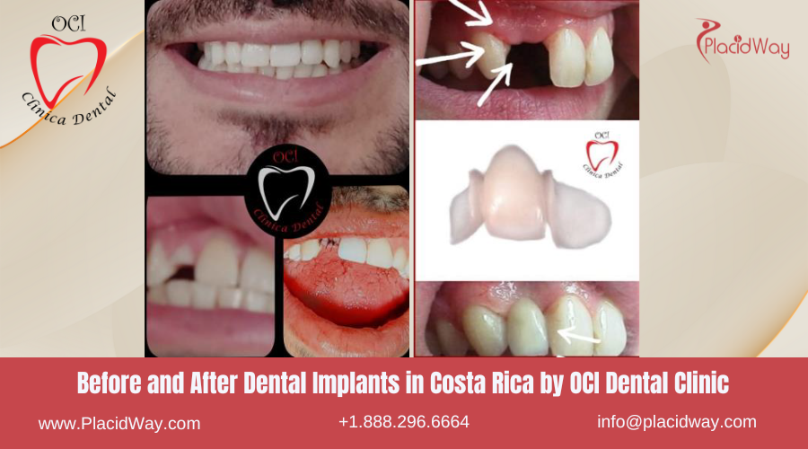 Dental Implants in Costa Rica by OCI Dental Clinic - Before and After