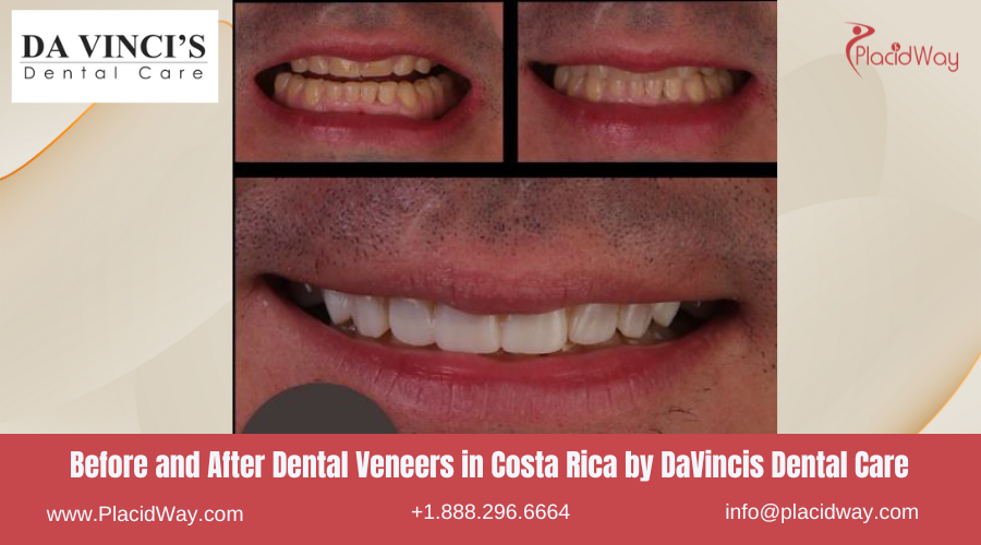 Dental Veneers in Costa Rica by DaVincis Dental Care - Before and After