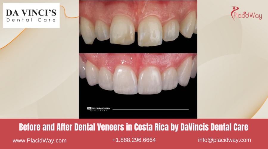 Teeth Veneers in Costa Rica by DaVincis Dental Care - Before and After