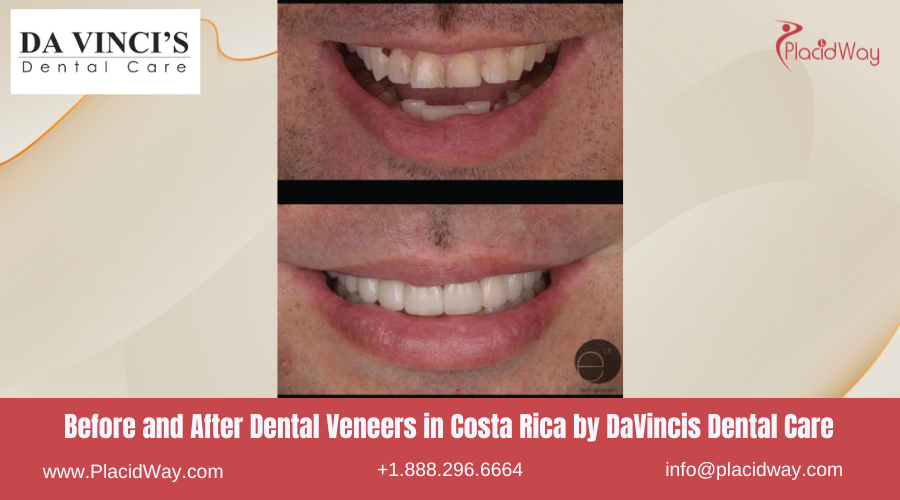 Dental Veneers in Costa Rica by DaVincis Dental Care Before and After Image