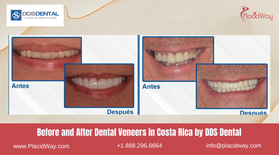 Dental Veneers in Costa Rica by DDS Dental - Before and After