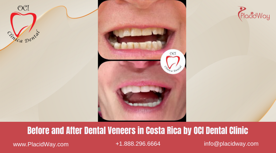 Dental Veneers in Costa Rica by OCI Dental Clinic - Before and After