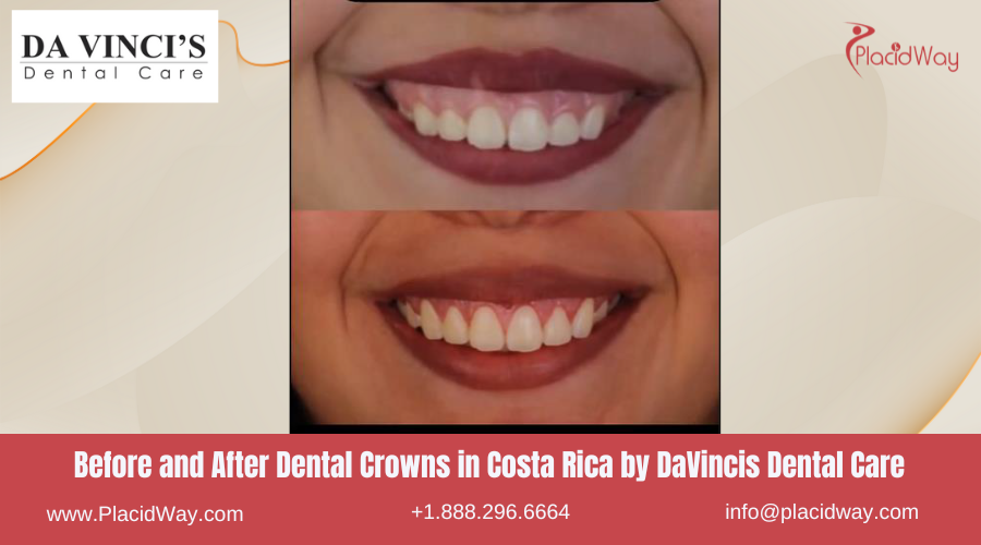 Dental Crowns in Costa Rica by DaVincis Dental Care - Before and After