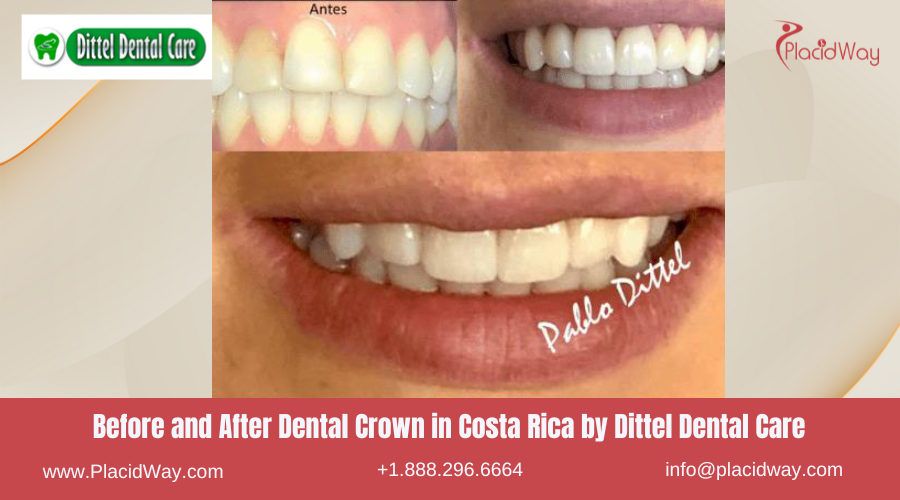 Dental Crowns in Costa Rica by Dittel Dental Care - Before and After