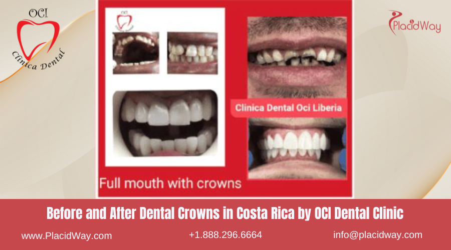 Dental Crowns in Costa Rica by OCI Dental Clinic- Before and After