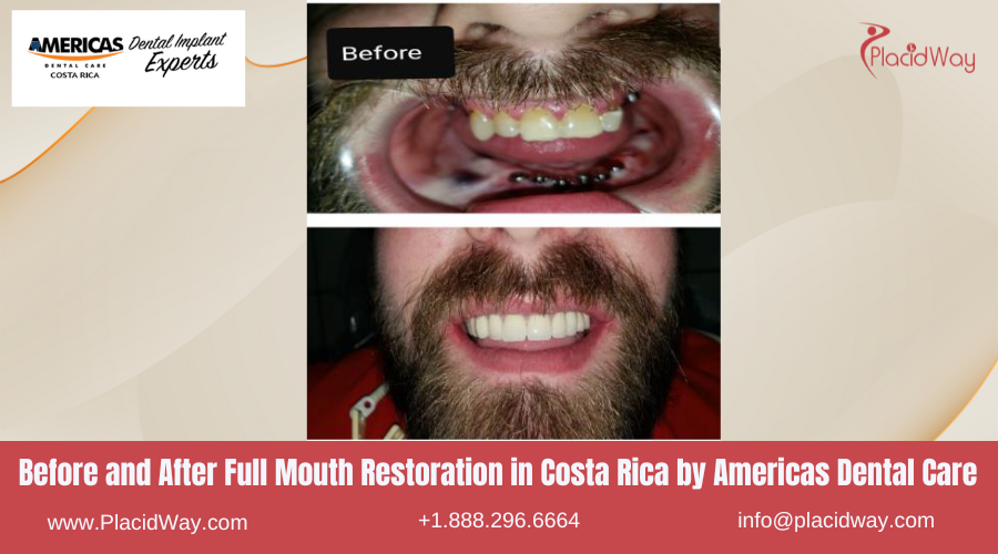 Full Mouth Restoration in Costa Rica by Americas Dental Care - Before and After