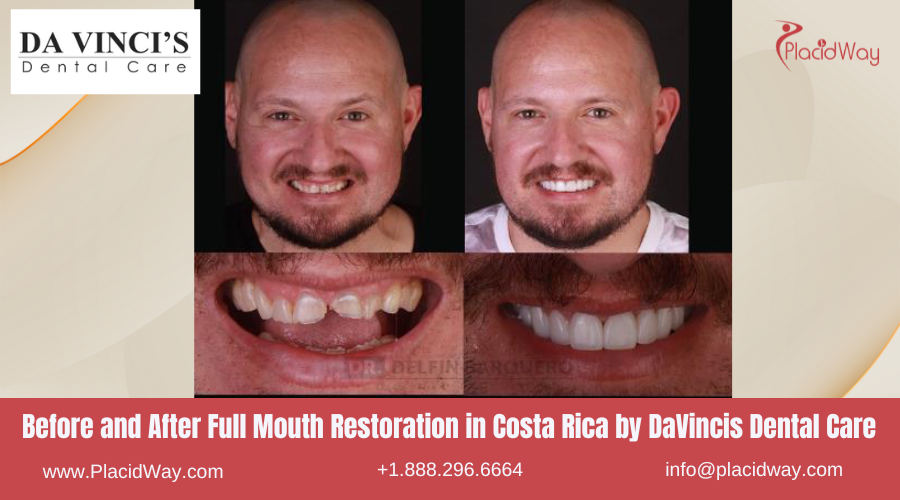 Full Mouth Restoration in Costa Rica by DaVincis Clinic - Before and After