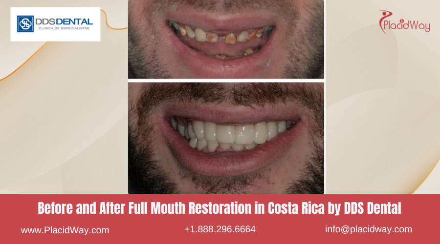 Full Mouth Restoration in Costa Rica by DDS Dental - Before and After