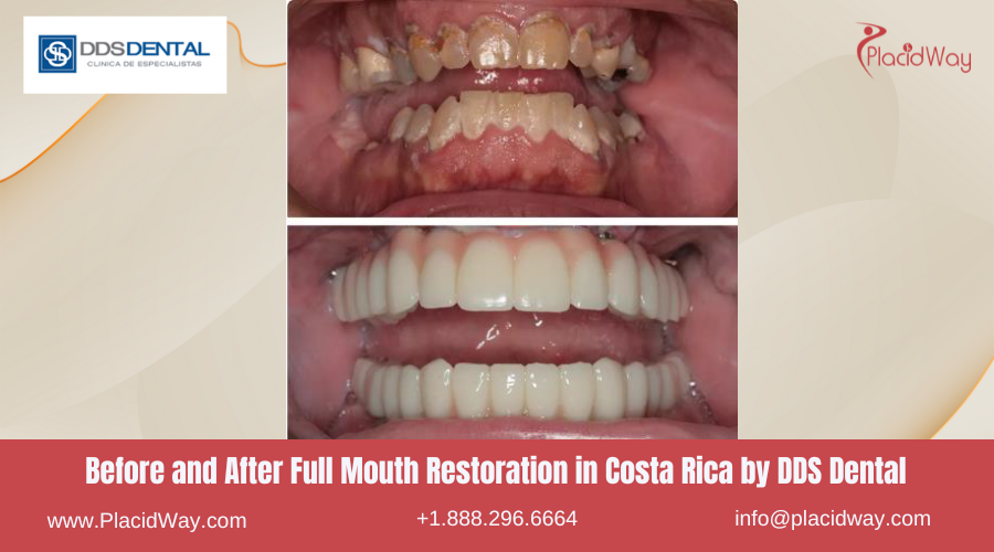 Full Mouth Restoration in Costa Rica by DDS Dental Clinic - Before and After