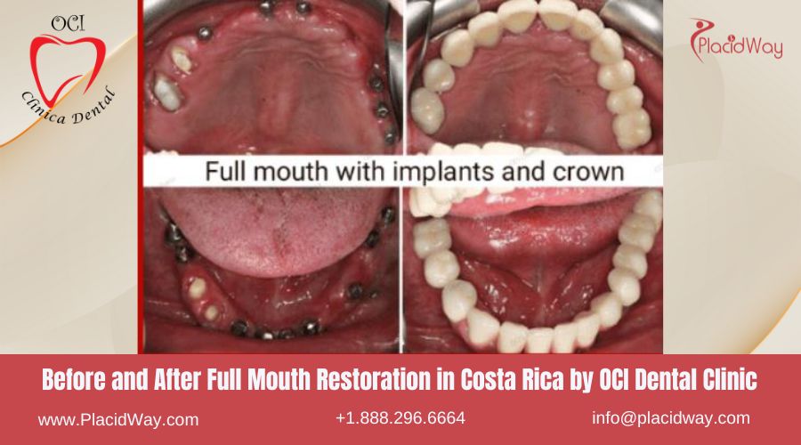 Full Mouth Restoration in Costa Rica by OCI Dental - Before and After