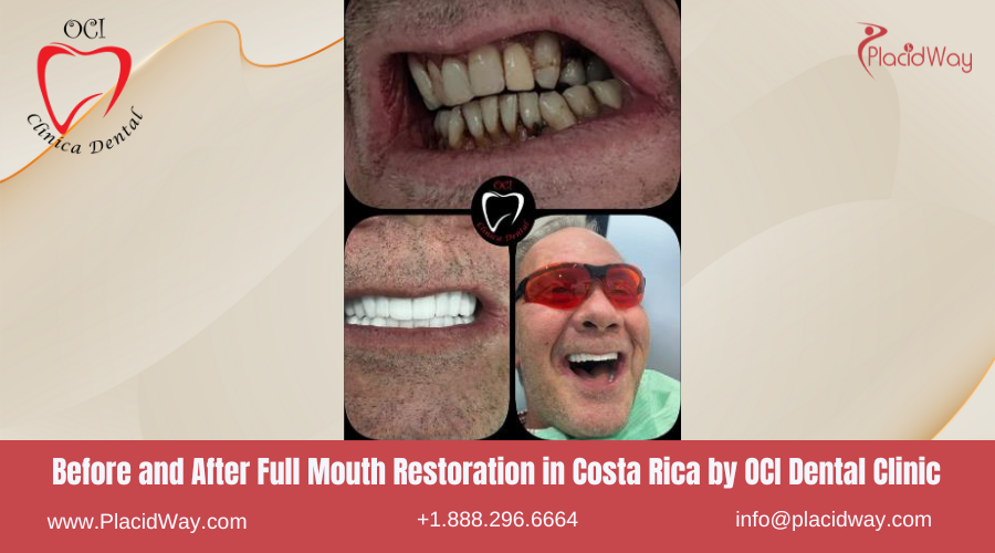 Full Mouth Restoration in Costa Rica by Dental Clinic OCI Liberia - Before and After