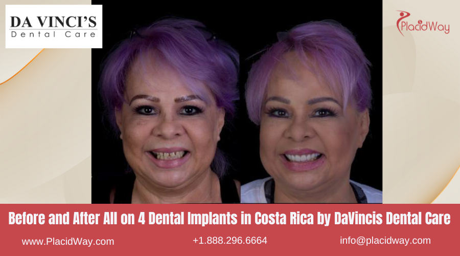 All on 4 Dental Implants in Costa Rica by DaVincis Dental Care - Before and After