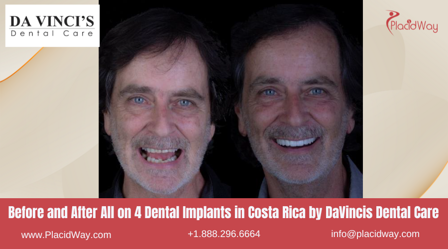 All on Four Dental Implants in Costa Rica by DaVincis Dental Care - Before and After