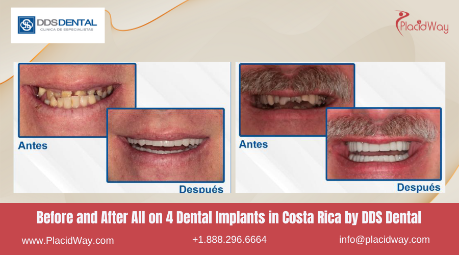 All on 4 Dental Implants in Costa Rica by DDS Dental - Before and After