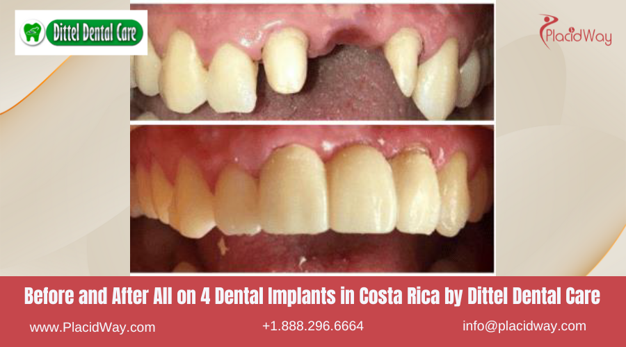 All on 4 Dental Implants in Costa Rica by Dittel Dental Care - Before and After
