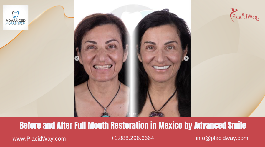 Full Mouth Restoration in Mexico Before and After Image by Advanced Smile Dentistry