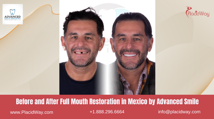 Full Mouth Restoration in Mexico Before and After Image by Advanced Smile