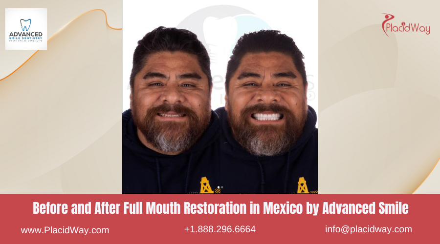 Full Mouth Restoration in Mexico Before and After Image by Advanced Smile Dentistry Clinic