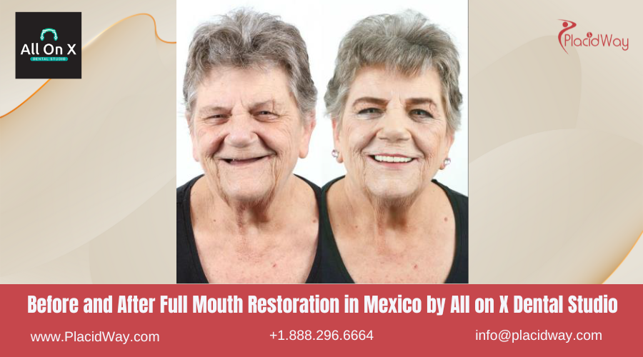 Full Mouth Restoration in Mexico Before and After Image by All on X Dental Studio