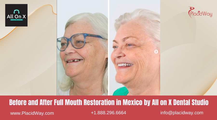 Full Mouth Restoration in Mexico Before and After Image by All on X