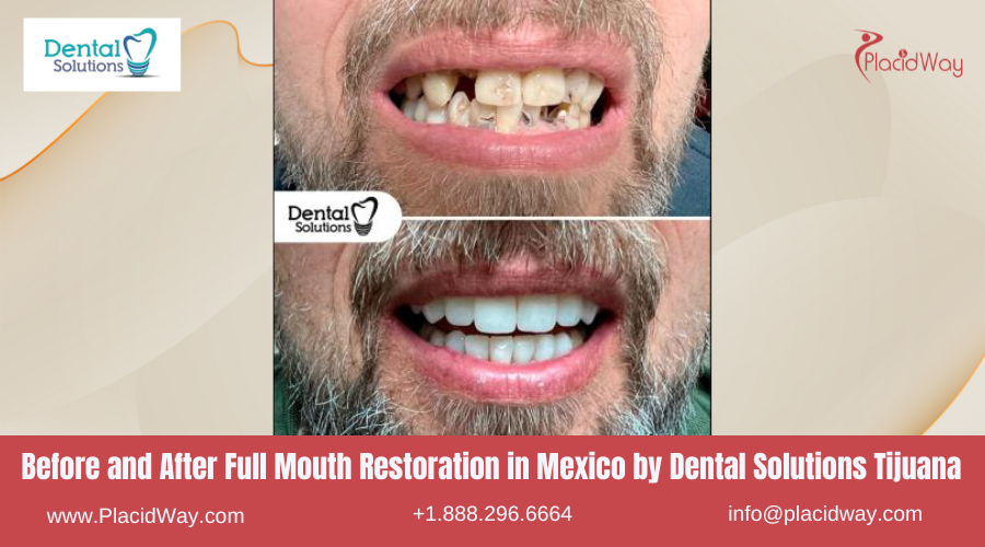 Full Mouth Restoration in Mexico Before and After Image by Dental Solutions