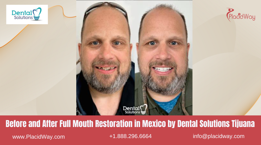 Full Mouth Restoration in Mexico Before and After Image by Dental Solutions Clinic