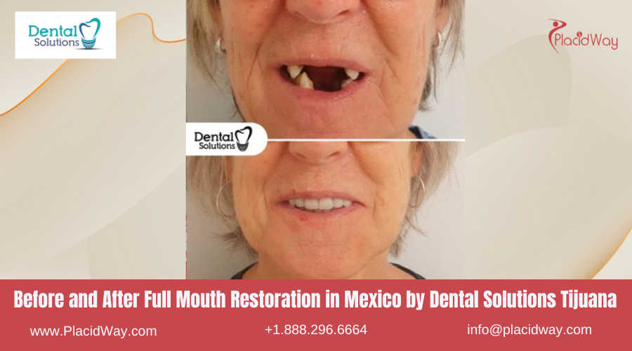 Full Mouth Restoration in Mexico Before and After Image by DS