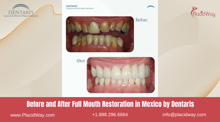 Full Mouth Restoration in Mexico Before and After Image by Dentaris