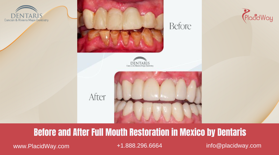 Full Mouth Restoration in Mexico Before and After Image by Dentaris Clinic