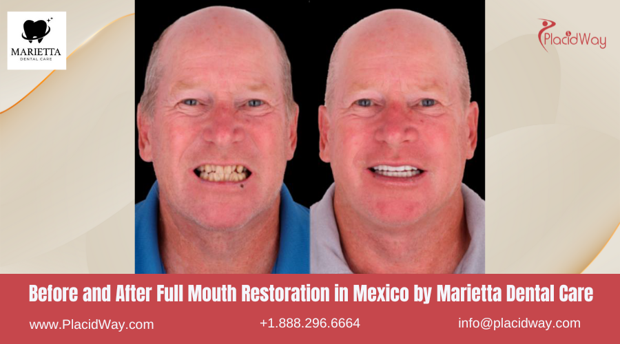 Full Mouth Restoration in Mexico Before and After Image by Marietta Dental Care