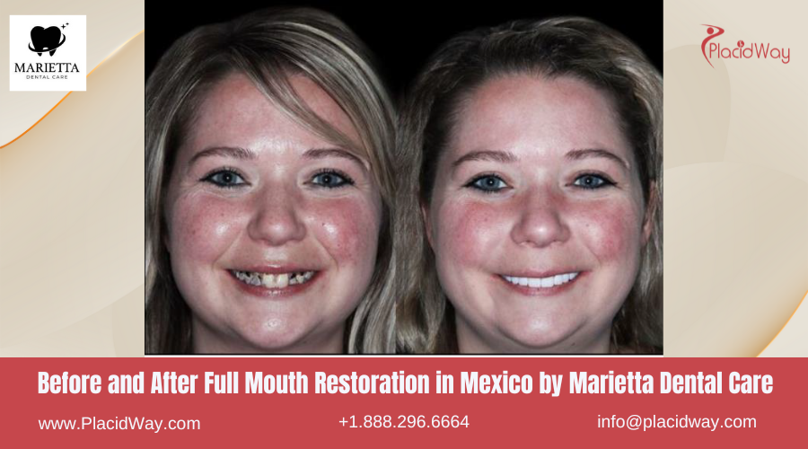 Full Mouth Restoration in Mexico Before and After Image by Marietta Dental Clinic