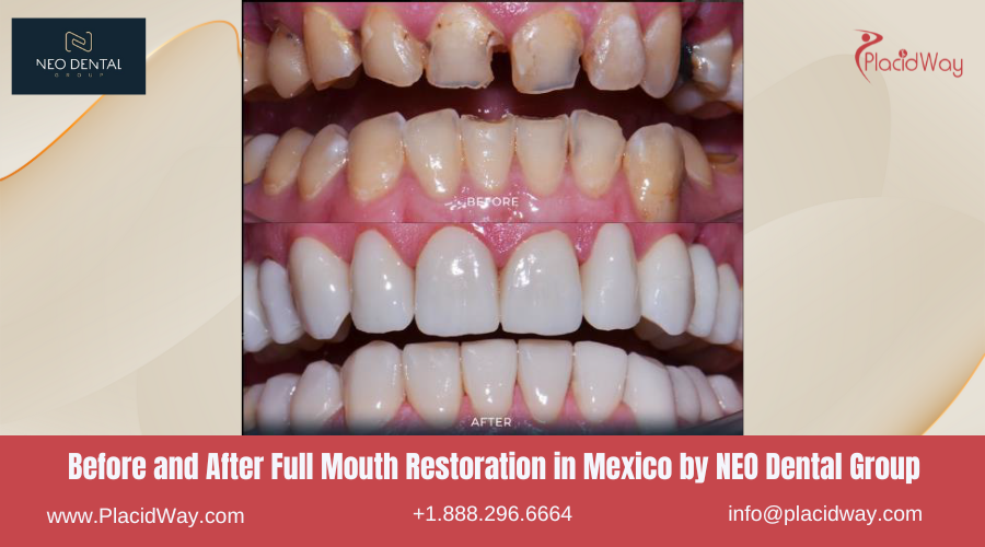 Full Mouth Restoration in Mexico Before and After Image by NEO Dental Group