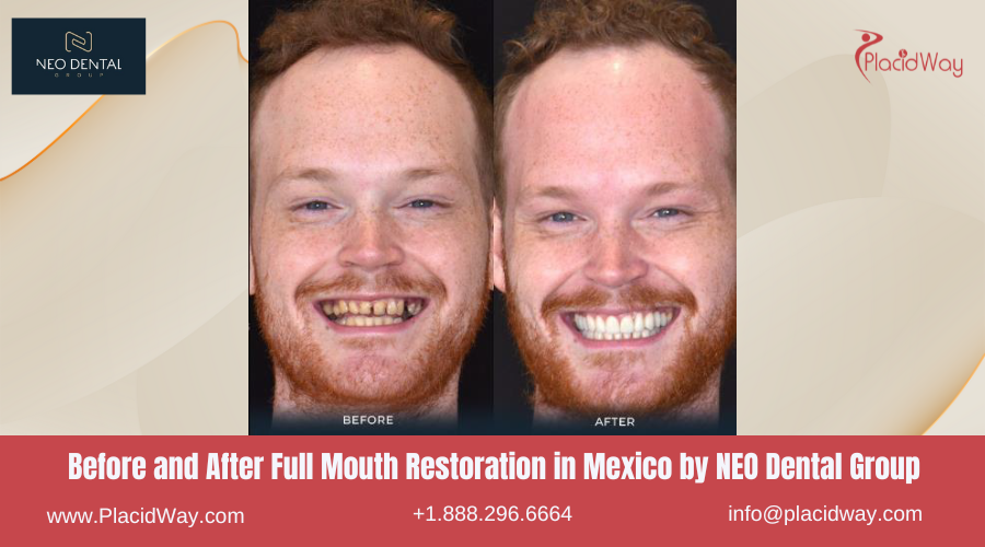 Full Mouth Restoration in Mexico Before and After Image by NEO Dental Clinic